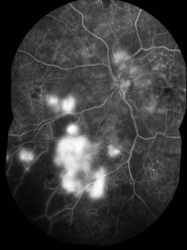 FA showing NVE, NVD, non- perfusion left eye inferonasally with neovascularization at the margin of the non-perfusion
