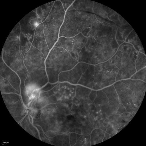 FA showing NVE, NVD, non- perfusion left eye inferonasally with neovascularization at the margin of the non-perfusion

