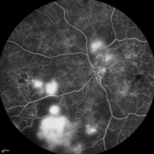 FA showing NVE, NVD, non- perfusion left eye inferonasally with neovascularization at the margin of the non-perfusion
