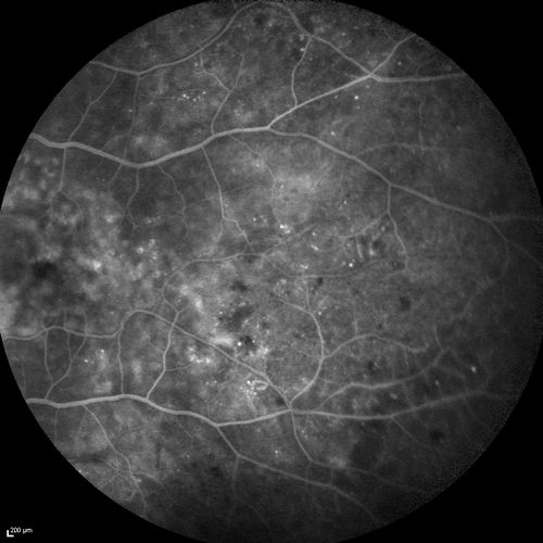 FA showing NVE, NVD, non- perfusion left eye inferonasally with neovascularization at the margin of the non-perfusion
