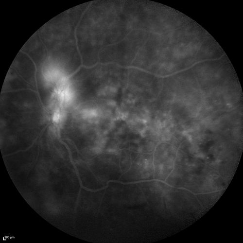 FA showing NVE, NVD, non- perfusion left eye inferonasally with neovascularization at the margin of the non-perfusion

