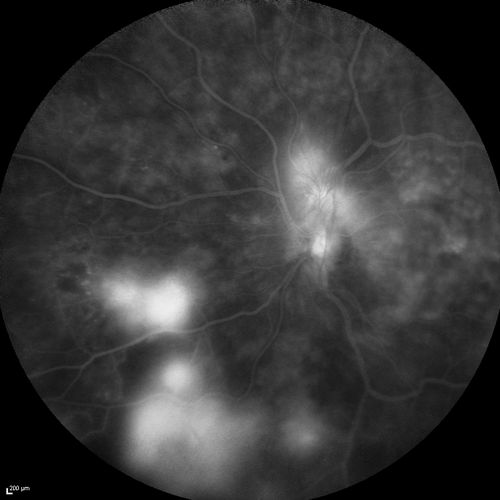 FA showing NVE, NVD, non- perfusion left eye inferonasally with neovascularization at the margin of the non-perfusion

