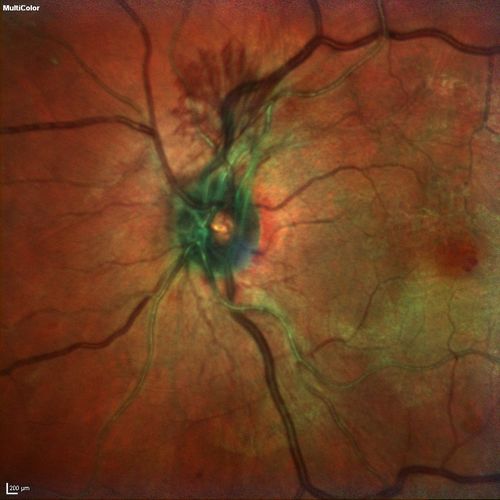 Neovascularization of the Disc - Heidelberg false color 
