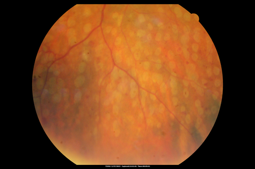 Panretinal (Scatter) Photocoagulation (Fresh)
