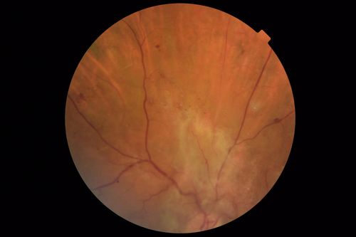 Severe PDR with preretinal fibrosis
71 year old female untreated for a year following injections because of hurricane Irma.  VA 20/30 OD and 5/200 OS.  Sudden vision loss 1 month ago left eye was likely an ischemic event.  Right eye is being treated with injections and PRP laser.
