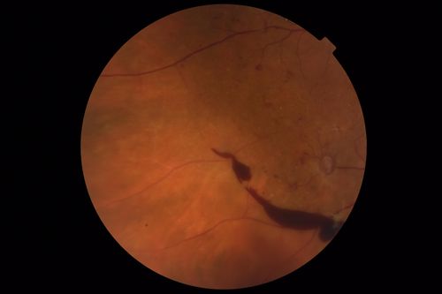 Severe PDR with preretinal fibrosis
71 year old female untreated for a year following injections because of hurricane Irma.  VA 20/30 OD and 5/200 OS.  Sudden vision loss 1 month ago left eye was likely an ischemic event.  Right eye is being treated with injections and PRP laser.
