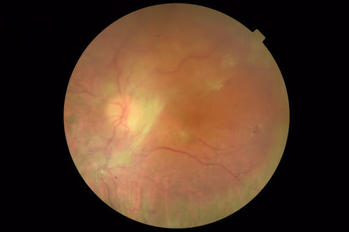 Severe PDR with preretinal fibrosis
71 year old female untreated for a year following injections because of hurricane Irma.  VA 20/30 OD and 5/200 OS.  Sudden vision loss 1 month ago left eye was likely an ischemic event.  Right eye is being treated with injections and PRP laser.
