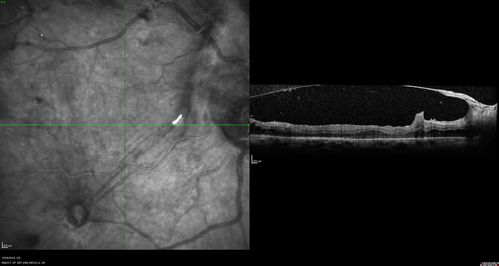 Severe PDR with preretinal fibrosis
71 year old female untreated for a year following injections because of hurricane Irma.  VA 20/30 OD and 5/200 OS.  Sudden vision loss 1 month ago left eye was likely an ischemic event.  Right eye is being treated with injections and PRP laser.

