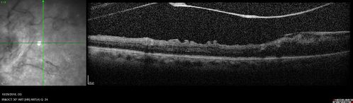 Severe PDR with preretinal fibrosis
71 year old female untreated for a year following injections because of hurricane Irma.  VA 20/30 OD and 5/200 OS.  Sudden vision loss 1 month ago left eye was likely an ischemic event.  Right eye is being treated with injections and PRP laser.
