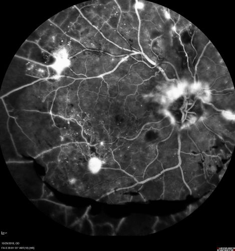 Severe PDR with preretinal fibrosis
71 year old female untreated for a year following injections because of hurricane Irma.  VA 20/30 OD and 5/200 OS.  Sudden vision loss 1 month ago left eye was likely an ischemic event.  Right eye is being treated with injections and PRP laser.
