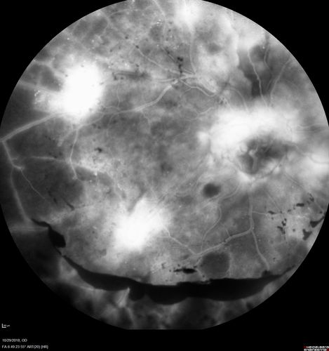 Severe PDR with preretinal fibrosis
71 year old female untreated for a year following injections because of hurricane Irma.  VA 20/30 OD and 5/200 OS.  Sudden vision loss 1 month ago left eye was likely an ischemic event.  Right eye is being treated with injections and PRP laser.
