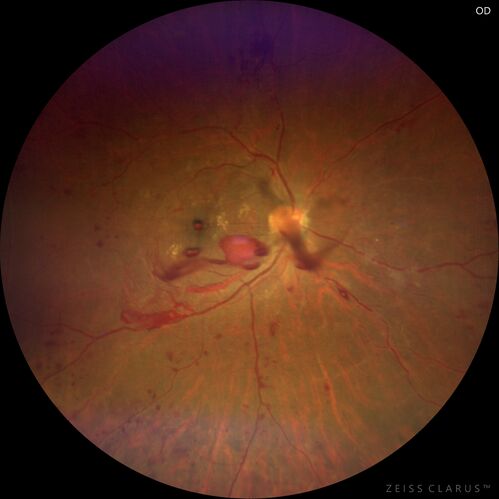 Severe Proliferative Diabetic Retinopathy and Good Vision
49 year old man with vision loss in the right eye for 2 weeks.  VA 20/40 OD, 20/63 OS.  DM x 15 years and HTN.
