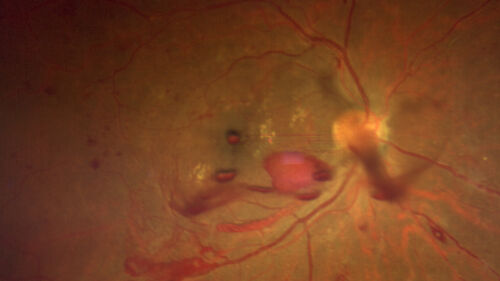 Severe Proliferative Diabetic Retinopathy and Good Vision
49 year old man with vision loss in the right eye for 2 weeks.  VA 20/40 OD, 20/63 OS.  DM x 15 years and HTN.
