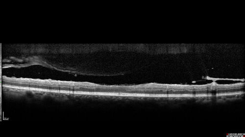 Severe Proliferative Diabetic Retinopathy and Good Vision
49 year old man with vision loss in the right eye for 2 weeks.  VA 20/40 OD, 20/63 OS.  DM x 15 years and HTN.
