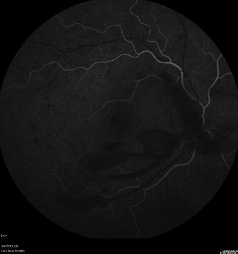 Severe Proliferative Diabetic Retinopathy and Good Vision
49 year old man with vision loss in the right eye for 2 weeks.  VA 20/40 OD, 20/63 OS.  DM x 15 years and HTN.
