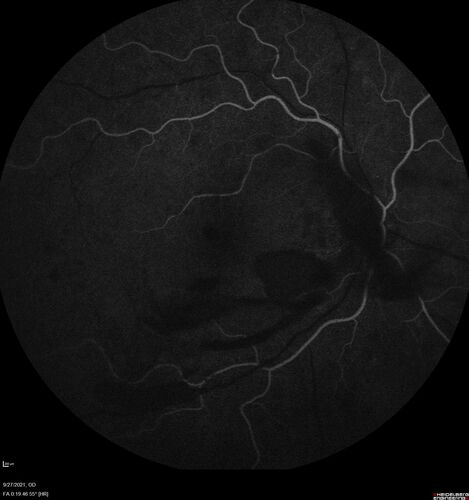 Severe Proliferative Diabetic Retinopathy and Good Vision
49 year old man with vision loss in the right eye for 2 weeks.  VA 20/40 OD, 20/63 OS.  DM x 15 years and HTN.
