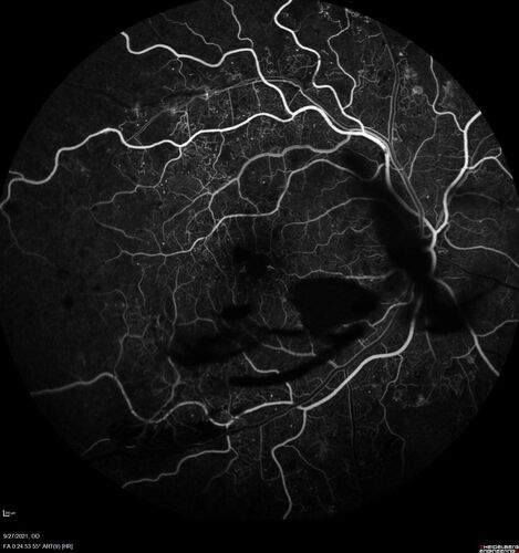 Severe Proliferative Diabetic Retinopathy and Good Vision
49 year old man with vision loss in the right eye for 2 weeks.  VA 20/40 OD, 20/63 OS.  DM x 15 years and HTN.
