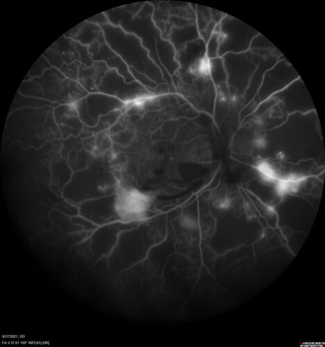 Severe Proliferative Diabetic Retinopathy and Good Vision
49 year old man with vision loss in the right eye for 2 weeks.  VA 20/40 OD, 20/63 OS.  DM x 15 years and HTN.
