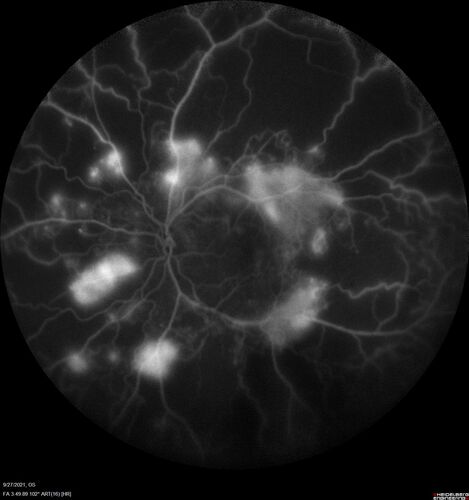 Severe Proliferative Diabetic Retinopathy and Good Vision
49 year old man with vision loss in the right eye for 2 weeks.  VA 20/40 OD, 20/63 OS.  DM x 15 years and HTN.

