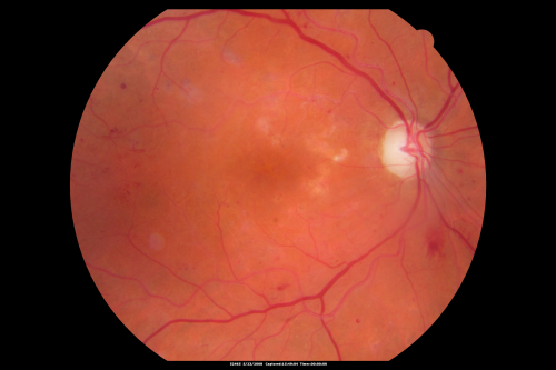 Diabetic Retinopathy - Non-Perfusion - Possible Central Retinal Vein Occlusion
68-year-old woman OD 20/70, OS 20/200 CYSTOID MACULAR EDEMA, POSSIBLE EITHER OCULAR ISCHEMIC SYNDROME IN THE RIGHT EYE OR OCCULT CENTRAL RETINAL VEIN OCCLUSION IN THE RIGHT EYE,S EVERE NON-PerfUSION WITH DIABETIC RETINOPATHY IN THE LEFT EYE.
Keywords: diabetic;non-perfusion;nonperfusion;central retinal vein occlusion