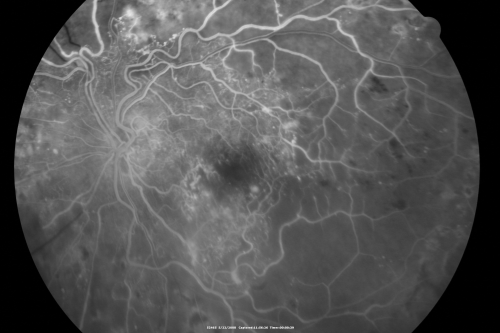 Diabetic Retinopathy - Non-Perfusion - Possible Central Retinal Vein Occlusion
68-year-old woman OD 20/70, OS 20/200 CYSTOID MACULAR EDEMA, POSSIBLE EITHER OCULAR ISCHEMIC SYNDROME IN THE RIGHT EYE OR OCCULT CENTRAL RETINAL VEIN OCCLUSION IN THE RIGHT EYE,S EVERE NON-PerfUSION WITH DIABETIC RETINOPATHY IN THE LEFT EYE.
Keywords: diabetic;non-perfusion;nonperfusion;central retinal vein occlusion