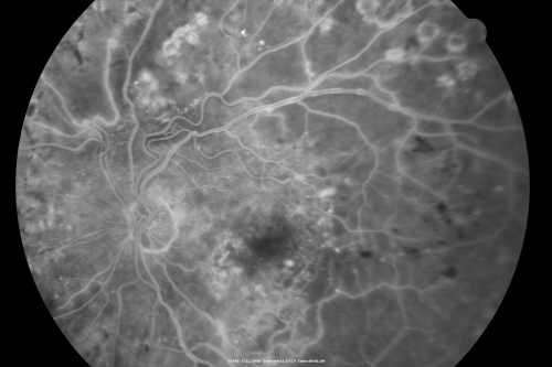 Diabetic Retinopathy - Non-Perfusion - Possible Central Retinal Vein Occlusion
68-year-old woman OD 20/70, OS 20/200 CYSTOID MACULAR EDEMA, POSSIBLE EITHER OCULAR ISCHEMIC SYNDROME IN THE RIGHT EYE OR OCCULT CENTRAL RETINAL VEIN OCCLUSION IN THE RIGHT EYE,S EVERE NON-PerfUSION WITH DIABETIC RETINOPATHY IN THE LEFT EYE.
Schlüsselwörter: diabetic;non-perfusion;nonperfusion;central retinal vein occlusion