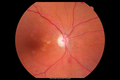 Diabetic Retinopathy - Non-Perfusion - Possible Central Retinal Vein Occlusion
68-year-old woman OD 20/70, OS 20/200 CYSTOID MACULAR EDEMA, POSSIBLE EITHER OCULAR ISCHEMIC SYNDROME IN THE RIGHT EYE OR OCCULT CENTRAL RETINAL VEIN OCCLUSION IN THE RIGHT EYE,S EVERE NON-PerfUSION WITH DIABETIC RETINOPATHY IN THE LEFT EYE.
Võtmesõnad: diabetic;non-perfusion;nonperfusion;central retinal vein occlusion