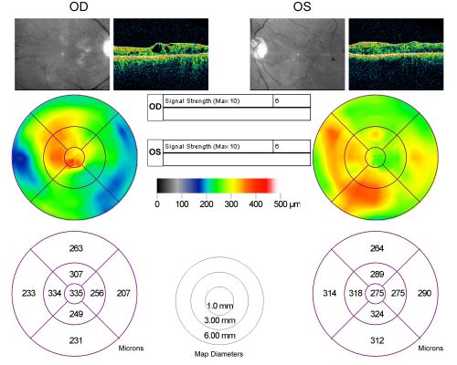 Diabetic Retinopathy - Non-Perfusion - Possible Central Retinal Vein Occlusion
68-year-old woman OD 20/70, OS 20/200 CYSTOID MACULAR EDEMA, POSSIBLE EITHER OCULAR ISCHEMIC SYNDROME IN THE RIGHT EYE OR OCCULT CENTRAL RETINAL VEIN OCCLUSION IN THE RIGHT EYE,S EVERE NON-PerfUSION WITH DIABETIC RETINOPATHY IN THE LEFT EYE.
Keywords: diabetic;non-perfusion;nonperfusion;central retinal vein occlusion