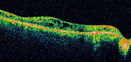 Diabetic Retinopathy - Non-Perfusion - Possible Central Retinal Vein Occlusion
68-year-old woman OD 20/70, OS 20/200 CYSTOID MACULAR EDEMA, POSSIBLE EITHER OCULAR ISCHEMIC SYNDROME IN THE RIGHT EYE OR OCCULT CENTRAL RETINAL VEIN OCCLUSION IN THE RIGHT EYE,S EVERE NON-PerfUSION WITH DIABETIC RETINOPATHY IN THE LEFT EYE.
Keywords: diabetic;non-perfusion;nonperfusion;central retinal vein occlusion