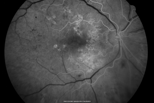 Diabetic Retinopathy - Non-Perfusion - Possible Central Retinal Vein Occlusion
68-year-old woman OD 20/70, OS 20/200 CYSTOID MACULAR EDEMA, POSSIBLE EITHER OCULAR ISCHEMIC SYNDROME IN THE RIGHT EYE OR OCCULT CENTRAL RETINAL VEIN OCCLUSION IN THE RIGHT EYE,S EVERE NON-PerfUSION WITH DIABETIC RETINOPATHY IN THE LEFT EYE.
Keywords: diabetic;non-perfusion;nonperfusion;central retinal vein occlusion