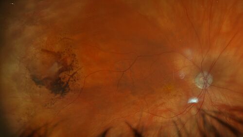 PECHR - 9 month follow-up pigment where blood was
