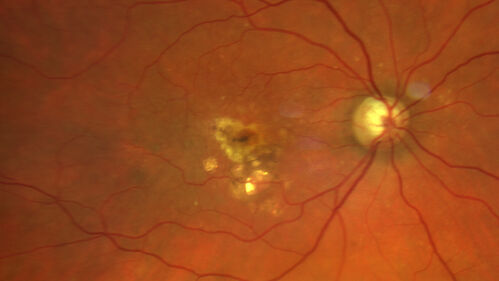 Pigment epithelial detachment with cholesterol crystals
Onion sign
