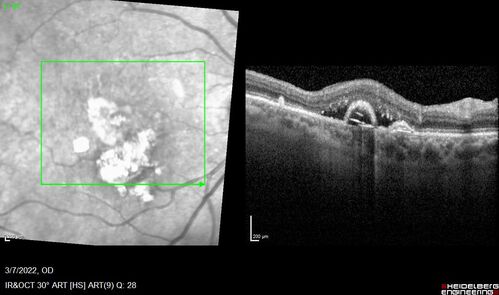 Pigment epithelial detachment with cholesterol crystals
Onion sign
