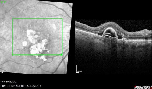 Pigment epithelial detachment with cholesterol crystals
Onion sign
