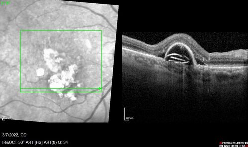 Pigment epithelial detachment with cholesterol crystals
Onion sign
