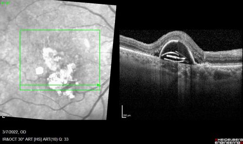 Pigment epithelial detachment with cholesterol crystals
Onion sign
