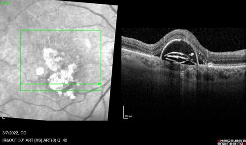 Pigment epithelial detachment with cholesterol crystals
Onion sign

