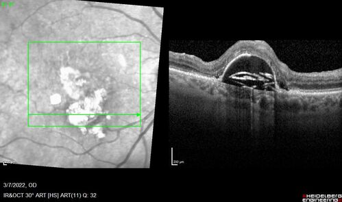 Pigment epithelial detachment with cholesterol crystals
Onion sign
