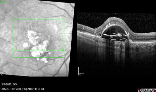 Pigment epithelial detachment with cholesterol crystals
Onion sign
