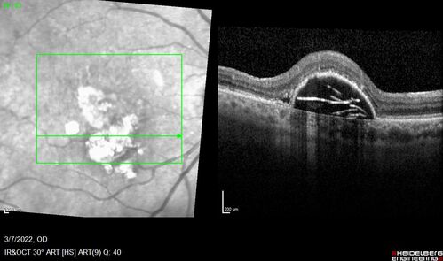 Pigment epithelial detachment with cholesterol crystals
Onion sign
