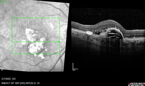 Pigment epithelial detachment with cholesterol crystals
Onion sign
