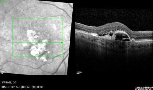Pigment epithelial detachment with cholesterol crystals
Onion sign
