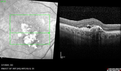 Pigment epithelial detachment with cholesterol crystals
Onion sign
