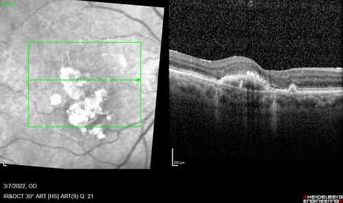 Pigment epithelial detachment with cholesterol crystals
Onion sign
