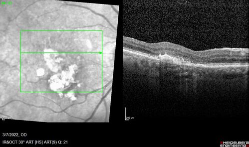 Pigment epithelial detachment with cholesterol crystals
Onion sign
