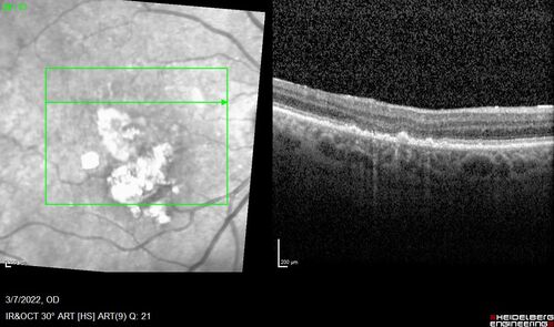 Pigment epithelial detachment with cholesterol crystals
Onion sign
