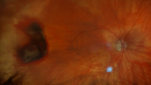 PEHCR - Peripheral Exudative Hemorrhagic Chorioretinopathy
