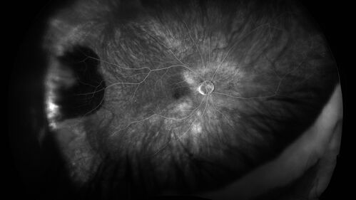 PEHCR - Peripheral Exudative Hemorrhagic Chorioretinopathy
