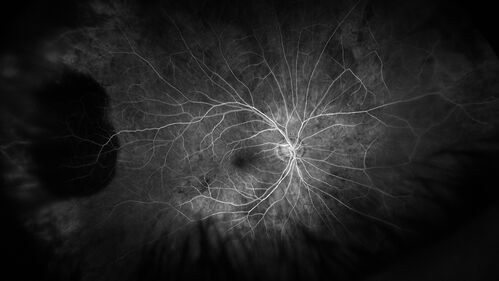 PEHCR - Peripheral Exudative Hemorrhagic Chorioretinopathy
