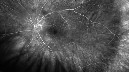 PEHCR - Peripheral Exudative Hemorrhagic Chorioretinopathy
